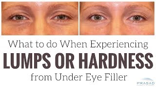 What to do When Experiencing Lumps or Hardness from Under Eye Filler [upl. by Akinnej577]