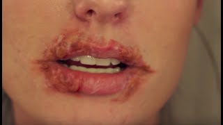 Cold Sore Herpes SFX Halloween Makeup Tutorial 2019  SMASHINBEAUTY [upl. by Hansiain]