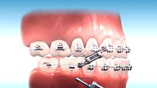 How to correct Class III Malocclusion [upl. by Edward245]