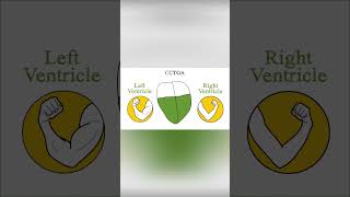 Congenitally corrected transposition of the great arteries CCTGA [upl. by Naruq]