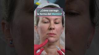 Corrección FACIAL impactante con Radiesse y Ácido Hialurónico [upl. by Atnovart502]