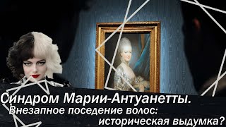 Синдром МарииАнтуанетты Внезапное поседение волос историческая выдумка [upl. by Aretina911]