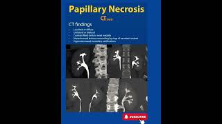 Papillary Necrosis  CT  Radiology [upl. by Eceryt10]