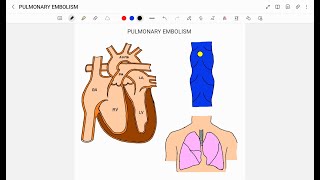 PULMONARY EMBOLISM [upl. by Aiva]