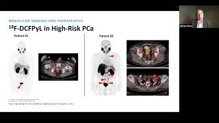 PSMATargeted PET Imaging amp Radioligand Therapy in the Management of Prostate Cancer [upl. by Bowen]