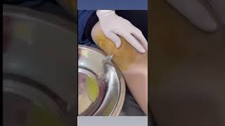 Draining fluid from knee [upl. by Kinzer279]