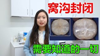 Teeth 101 All About Sealants  窝沟封闭是必要的吗 [upl. by Namzed]