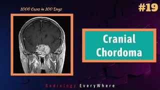 Cranial Chordoma  Radiology Tutorials  1000 cases in100 days  Radiology Everywhere  video 19 [upl. by Dammahum]