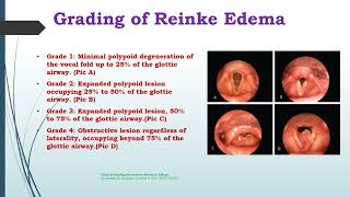 Reinke Edema [upl. by Nanette]