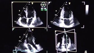 Triplane Echokardiographie triplane echocardiography [upl. by Anilosi]