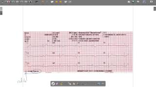 ECG Paper [upl. by Florian]