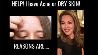 Why do I have ACNE or DRY patches on my skin [upl. by Clerk454]