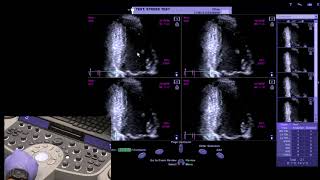 Piedmont Healthcare Stress Echo Protocol on Siemens SC2000 [upl. by Korfonta]