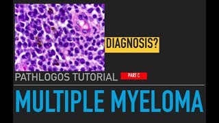 Multiple myeloma Pathology amp Diagnosis [upl. by Larry535]