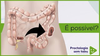 Tem como trocar de ileostomia para colostomia [upl. by Call]