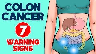 7 Warning Signs of Colon Cancer in 2024 [upl. by Zeb]