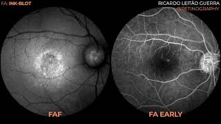 Inkblot pattern CSCR fluorescein angiography [upl. by Reinert]