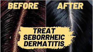 How to Treat Seborrheic Dermatitis Natural Hair Treatment  Repair Your Scalp amp Hair Loss [upl. by Aiasi]