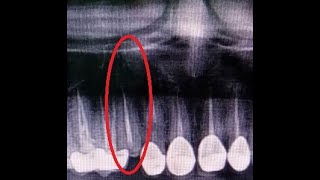 Maxillary canine tooth removal with Piezotome assisted [upl. by Etteloc]