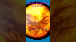 Smartphone Fundus Videography  Fundus Photography  Choroidal Coloboma  Short Video 53 [upl. by Levitt]