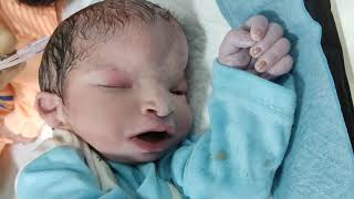 Cephalocele and congenital syndromic baby enchephalocele congenital anomaly newborn [upl. by Court]