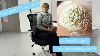 Verruca Wart Removal Laser Treatment [upl. by Aerahs826]