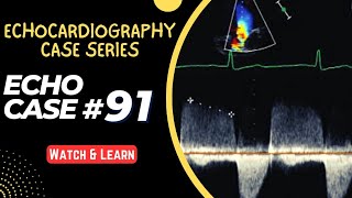 ECHO CASE 91  Echocardiography for Beginners  Echocardiogram Interpretation  2D Echo Basics [upl. by Noved]