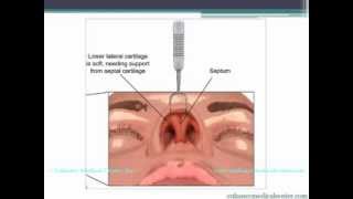 Organic Asian Rhinoplasty by Dr Charles S Lee [upl. by Nainatrad]