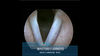 INYECCIÓN DE CUERDAS VOCALES  VOCAL FOLD INJECTION [upl. by Aihsei]