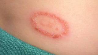 ringworm treatment for humans  This is the simplest way to encounter ringworm treatment for human [upl. by Michaelina]