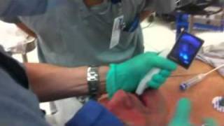 McGRATH MAC Video Laryngoscope  intubation 1 [upl. by Adehsar]