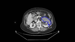 Renal angiomyolipoma with acute hemorrhage [upl. by Ric]