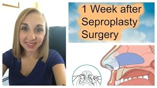 1 Week After Septoplasty Surgery [upl. by Minabe]