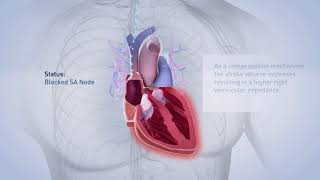 Biotronik pacemaker [upl. by Ettevahs]