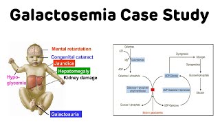 Galactosemia Case Study  Classical Galactosemia  NEXT PG Biochemistry [upl. by Allin191]