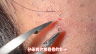 拔出皮肤下的胡子，发炎的毛囊Pull out the beard under the skin inflamed hair follicles [upl. by Ataga]