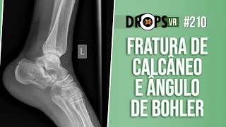 FRATURA DE CALCÂNEO E ÂNGULO DE BOHLER  RECONHECENDO PELA RADIOGRAFIA [upl. by Orgalim]