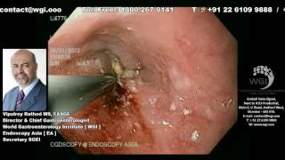 Endoscopic procedure of Esophageal Metal Stenting [upl. by Aemat]