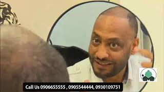 Yigerem Dejene one year hair transplant result Marcia Surgical Center [upl. by Aihsoj]