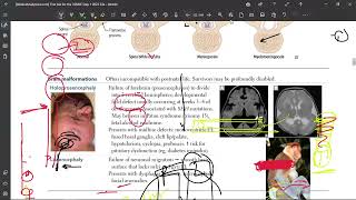 4 Holoprosencephaly [upl. by Lanahtan]