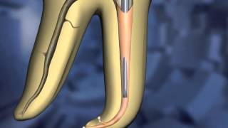 Calamus®  Hybrid Technique  Dentsply Sirona [upl. by Norling]