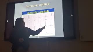 Cardiología  Estenosis aortica e Insuficiencia Aortica [upl. by Eilojne525]