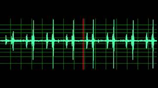 Pulmonary Associated Heart Sounds PAH Split S2 [upl. by Ecnesse]