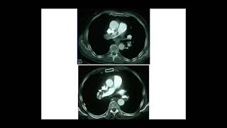 EMBOLIE PULMONAIRE Pr M METAHRI [upl. by Neellok]