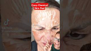 Crazy CHEMICAL PEEL  Anti Aging Peel Before and After shorts [upl. by Ardnuhsal]