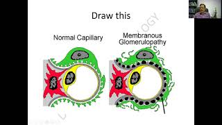 Nephrotic Syndrome Part  2 Membranous Glomerulonephritis MPGN FSGS  RATS in pathology [upl. by Gary78]