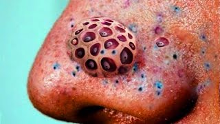 Blackheads Blackhead Removal and Trypophobia Disease [upl. by Lelah]