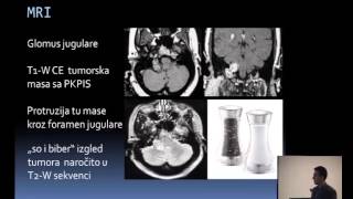 Glomus tumori glave i vrata dijagnostika i endovaskularni tretman Aleksandar Jovanoviski [upl. by Eirok]