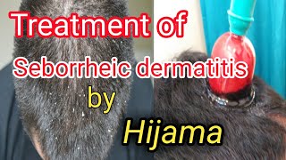 Hijamah in Seborrheic Dermatitis [upl. by Nihcas]