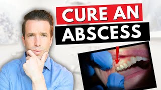 Dentist Explains a Tooth Abscess  How to Cure an Abscess Tooth [upl. by Ettevy]